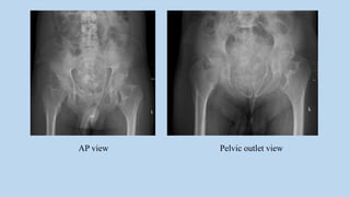 AP view Pelvic outlet view
 