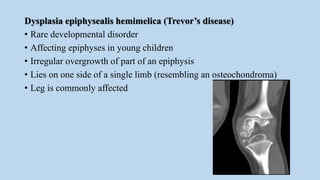 Dysplasia epiphysealis hemimelica (Trevor’s disease)
• Rare developmental disorder
• Affecting epiphyses in young children
• Irregular overgrowth of part of an epiphysis
• Lies on one side of a single limb (resembling an osteochondroma)
• Leg is commonly affected
 