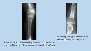 Distal femur and tibia showing multiple enchondromas
and distal femoral deformity consistent with Ollier’s d/s
Proximal phalangeal enchondroma
with associated pathological #
 