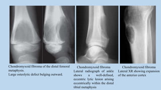 Chondromyxoid fibroma of the distal femoral
metaphysis.
Large osteolytic defect bulging outward.
Chondromyxoid fibroma
Lateral radiograph of ankle
shows a well-defined,
eccentric lytic lesion arising
eccentrically within the distal
tibial metaphysis
Chondromyxoid fibroma
Lateral XR showing expansion
of the anterior cortex
 