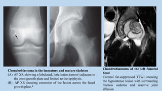 Chondroblastoma of the left femoral
head
Coronal fat-suppressed T2WI showing
the hypointense lesion with surrounding
marrow oedema and reactive joint
effusion
Chondroblastoma in the immature and mature skeleton
(A) AP XR showing a lobulated, lytic lesion (arrow) adjacent to
the open growth plate and limited to the epiphysis.
(B) AP XR showing extension of the lesion across the fused
growth plate.*
 