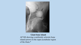 Giant bone island
AP XR showing a uniformly sclerotic bone
island (arrow) in the supra acetabular region
of the ilium.*
 