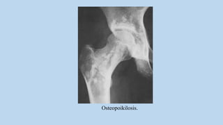 Osteopoikilosis.
 