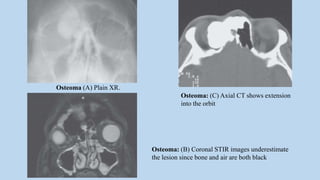 Osteoma: (C) Axial CT shows extension
into the orbit
Osteoma: (B) Coronal STIR images underestimate
the lesion since bone and air are both black
Osteoma (A) Plain XR.
 