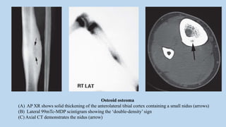 Osteoid osteoma
(A) AP XR shows solid thickening of the anterolateral tibial cortex containing a small nidus (arrows)
(B) Lateral 99mTc-MDP scintigram showing the ‘double-density’ sign
(C) Axial CT demonstrates the nidus (arrow)
 