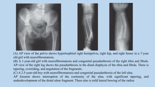 (A) AP view of the pelvis shows hypertrophied right hemipelvis, right hip, and right femur in a 7-year
old girl with neurofibromatosis.
(B) A 1-year-old girl with neurofibromatosis and congenital pseudarthrosis of the right tibia and fibula.
AP view of the right leg shows the pseudarthrosis in the distal diaphysis of the tibia and fibula. There is
tapering, overriding, and angulation of the fragments.
(C) A 2.5-year-old boy with neurofibromatosis and congenital pseudarthrosis of the left ulna.
AP forearm shows interruption of the continuity of the ulna, with significant tapering, and
underdevelopment of the distal ulnar fragment. There also is mild lateral bowing of the radius
 