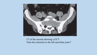 CT of the sacrum showing a GCT.
Note the extension to the left sacroiliac joint.*
 