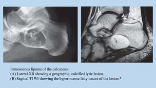 Intraosseous lipoma of the calcaneus.
(A) Lateral XR showing a geographic, calcified lytic lesion.
(B) Sagittal T1WI showing the hyperintense fatty nature of the lesion.*
 