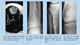 Axial T2WI showing a proximal
tibial NOF with relatively low SI
due to its fibrous nature.*
AP XR of the ankle
showing a classical distal
tibial NOF
AP XR showing a
diaphyseal fibrous cortical
defect of the proximal
tibia.*
AP XR of the distal
femur showing a benign
fibrous histiocytoma.*
 