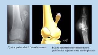 Typical pedunculated Osteochondroma Bizarre parosteal osteochondromatous
proliferation adjacent to the middle phalanx
 