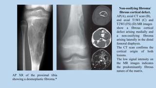 AP XR of the proximal tibia
showing a desmoplastic fibroma.*
Non-ossifying fibroma/
fibrous cortical defect.
AP(A), axial CT scan (B),
and axial T1WI (C) and
T2WI (FS) (D) MR images
show a fibrous cortical
defect arising medially and
a non-ossifying fibroma
arising laterally in the distal
femoral diaphysis.
The CT scan confirms the
cortical origin of both
lesions.
The low signal intensity on
the MR images indicates
the predominantly fibrous
nature of the matrix.
 