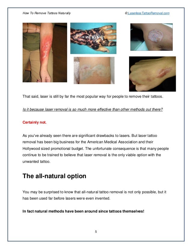 Tattoo Cream Diy Tattoo Removal