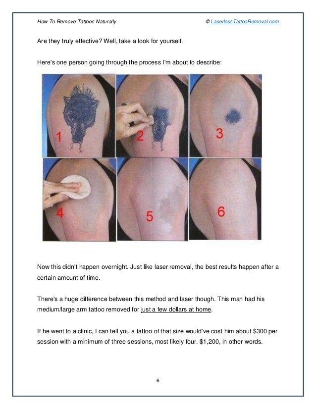 How To Remove A Tattoo Without Laser - How The Laser Seems To Be An Effective Procedure For Removing Tattoos Video Dailymotion / In that regard, there is no way we could have finished this guide without long at some of the natural.