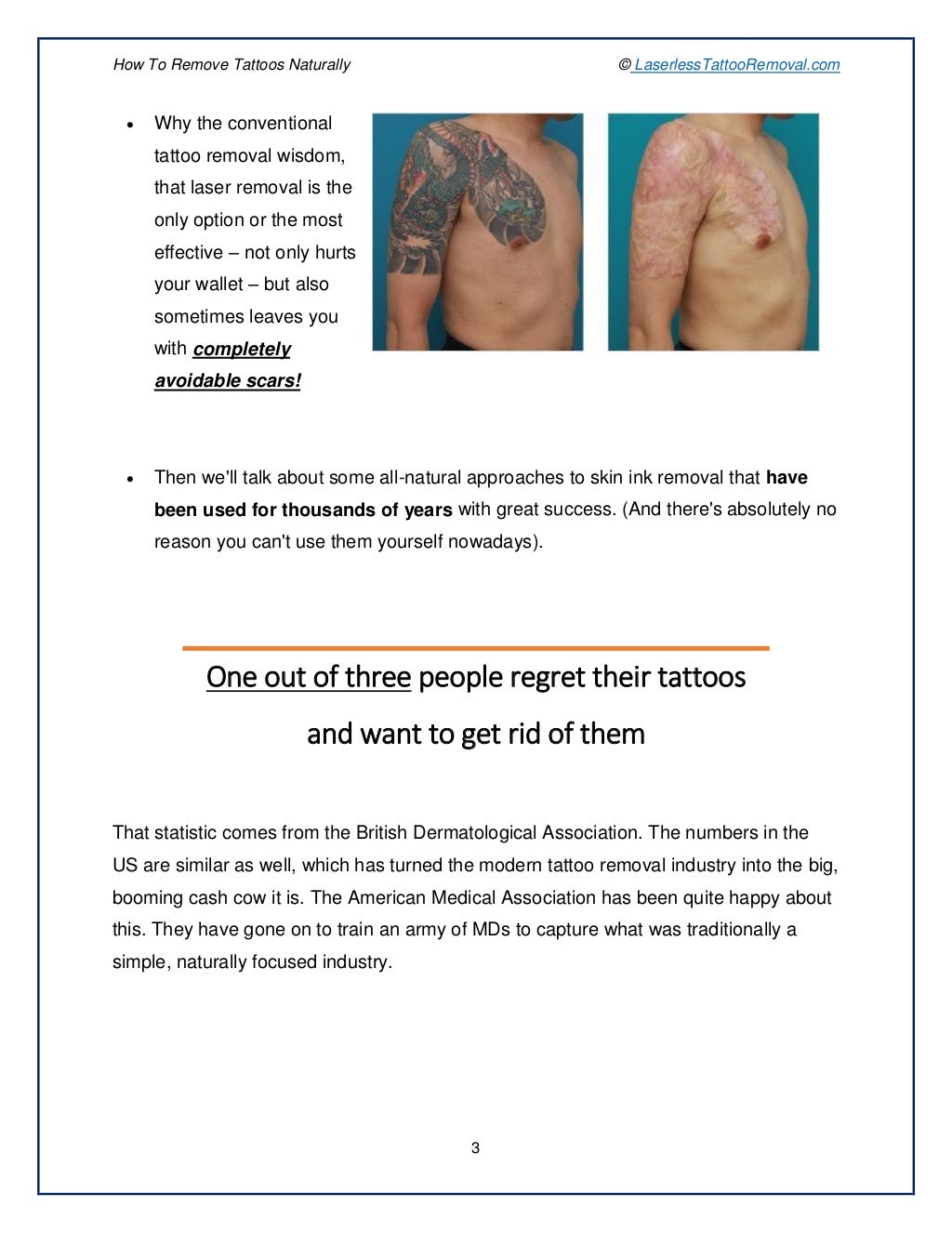 How Can I Remove My Tattoo Without Laser Tattoo Vanish Cost