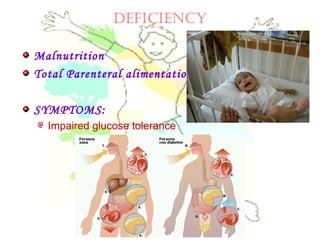 DEfICIENCy
Malnutrition
Total Parenteral alimentation
SYMPTOMS:
Impaired glucose tolerance
 