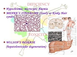 deficiency
Hypochromic, microcytic Anemia
MENKE’S SYNDROME (Steely or Kinky Hair
syndrome)
WILSON’S DISEASE
(hepatolenticular degeneration)
toxicity
 