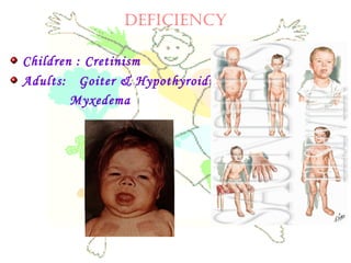 deficiency
Children : Cretinism
Adults: Goiter & Hypothyroidism
Myxedema
 