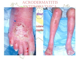 AcRodeRMAtitiS
enteRoPAtHicA
Specific multi-organ disorder
SYMPTOMS:
Diarrhea
Wide range of mucocutaneous problems
Eczematous, psoriasiform, vesicular lesions
 