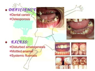 DEFICIENCY:
Dental caries
Osteoporosis
EXCESS:
Disturbed amelogenesis
Mottled enamel
Systemic fluorosis
 