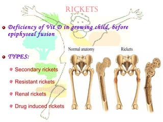 Deficiency of Vit D in growing child, before
epiphyseal fusion
TYPES:
Secondary rickets
Resistant rickets
Renal rickets
Drug induced rickets
RICKETS
 