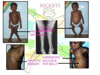 KNOCK KNEE
DEFORMITY
BOW LEG
DEFORMITY
RACHITIC
ROSARY
HARRISON’S
SULCUS &
POT BELLY
RICKETS
 