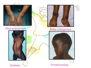 Wrist enlargement Ankle enlargement
Scoliosis Frontal bossing
 