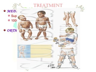 TREATMENT
MEDICAL INTERVENTION:
Supplementation of dietary Ca & Vit D
1000-5000 IU
ORTHOPEDIC INTERVENTION:
 