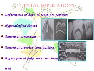 DENTAL IMPLICATIONS
Deformities of bone & teeth are common
Hypocalcified dentin
Abnormal cementum
Abnormal alveolar bone pattern
Highly placed pulp horns reaching up to DEJ are
seen
 