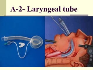 A-2- Laryngeal tube
 