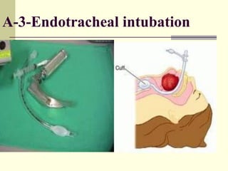 A-3-Endotracheal intubation
 