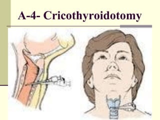 A-4- Cricothyroidotomy
 