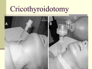 Cricothyroidotomy
 