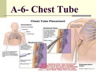 A-6- Chest Tube
 