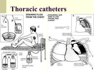 Thoracic catheters
 