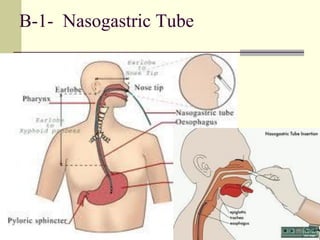 B-1- Nasogastric Tube
 