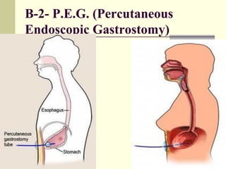 B-2- P.E.G. (Percutaneous
Endoscopic Gastrostomy)
 