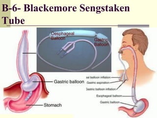 B-6- Blackemore Sengstaken
Tube
 