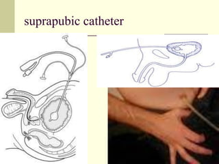 suprapubic catheter
 