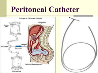 Peritoneal Catheter
 