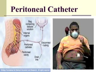 Peritoneal Catheter
 