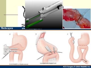 SUTURING & STAPLING
•Terminal End Staplers
•Internal Anastomosis Staplers
•End-to-End Circular Staplers
nursinglectures.blogspot.com
 