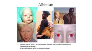 Albinism
• Albinism results from a mutation which prevents the formation of enzyme 3
(Melanocyte tyrosinase).
• As a result albinos fail to synthesize melanin.
 
