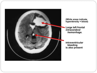 (White areas indicate
hyperdensity = blood)
Large left frontal
intracerebral
hemorrhage.
Intraventricular
bleeding
is also present
 