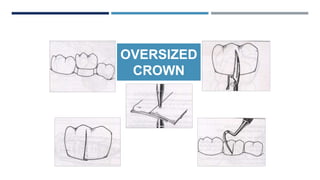 OVERSIZED
CROWN
 