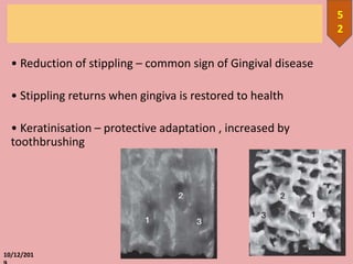 • Reduction of stippling – common sign of Gingival disease
• Stippling returns when gingiva is restored to health
• Keratinisation – protective adaptation , increased by
toothbrushing
10/12/201
5
2
 