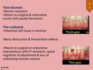 Thick blunted:
>Resists recession
>Reacts to surgical & restorative
insults with pocket formation
Thin scalloped:
>Attached soft tissue is minimal
>Bony dehiscence & fenestration defects
>Reacts to surgical or restorative
interventions with ST recession, apical
migration of attachment & loss of
underlying alveolar volume
10/12/201
6
7
 