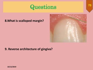 Questions
10/12/2019
73
8.What is scalloped margin?
9. Reverse architecture of gingiva?
 