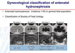 Gynecological classification of antenatal
hydronephrosis
• Antenatal hydronephrosis: incidence 1-5% in general fetal population
• Classification of Society of Fetal Urology

 
