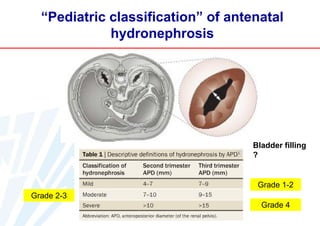 “Pediatric classification” of antenatal
hydronephrosis

Bladder filling
?

Grade 1-2
Grade 2-3
Grade 4

 