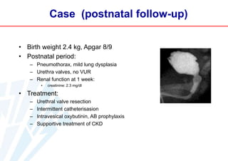 Case (postnatal follow-up)
• Birth weight 2.4 kg, Apgar 8/9
• Postnatal period:
– Pneumothorax, mild lung dysplasia
– Urethra valves, no VUR
– Renal function at 1 week:
•

creatinine: 2.3 mg/dl

• Treatment:
–
–
–
–

Urethral valve resection
Intermittent catheterisasion
Intravesical oxybutinin, AB prophylaxis
Supportive treatment of CKD

 